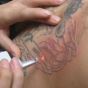 Клетки кожи научили сводить татуировки самостоятельно
