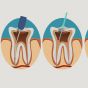 5 самых популярных мифов о заражении зубных каналов